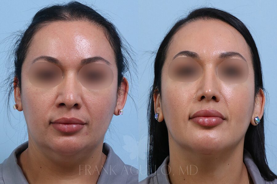 Rhinoplasty Before and After 5