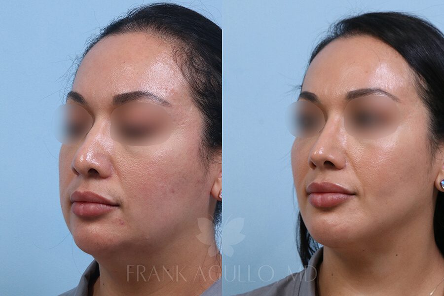 Rhinoplasty Before and After 2