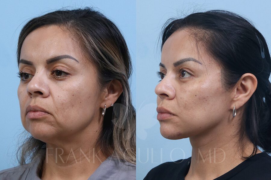 Face Lift Before and After 2