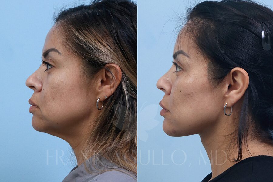 Face Lift Before and After 3