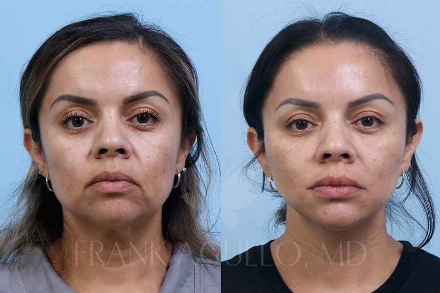 Face Lift Before and After 6