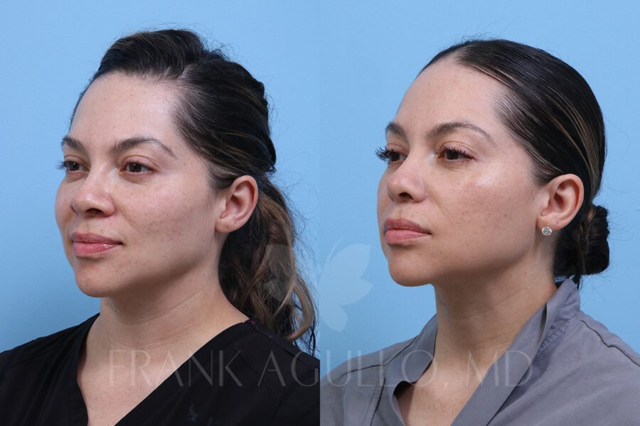 Rhinoplasty Before and After 2