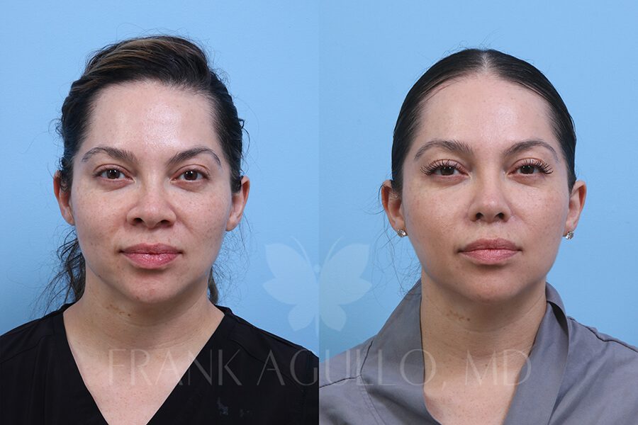 Rhinoplasty Before and After 6