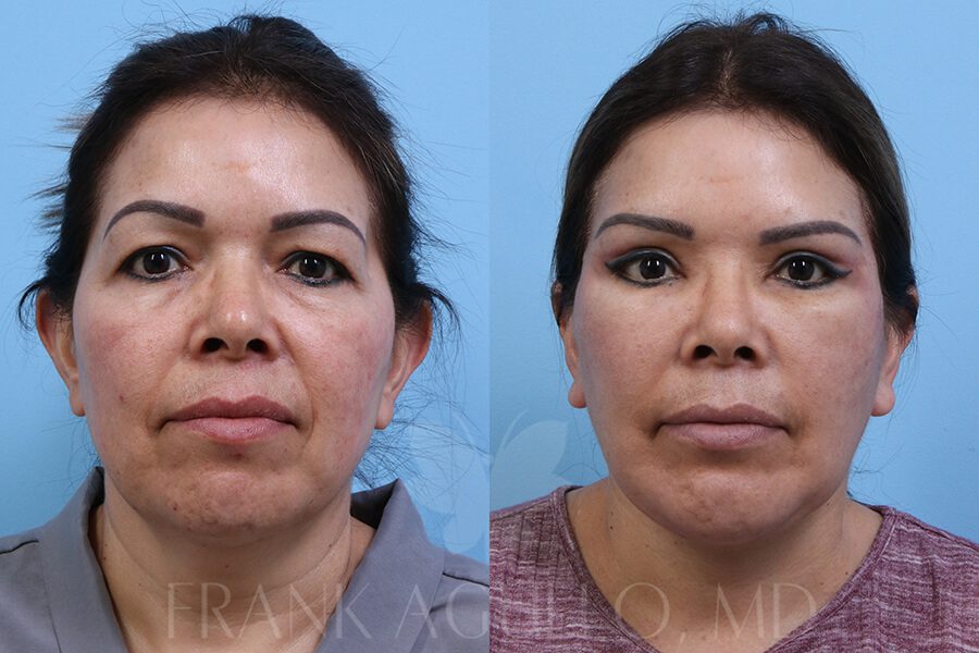 Face Lift Before and After 7
