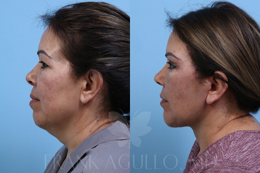 Face Lift Before and After 2