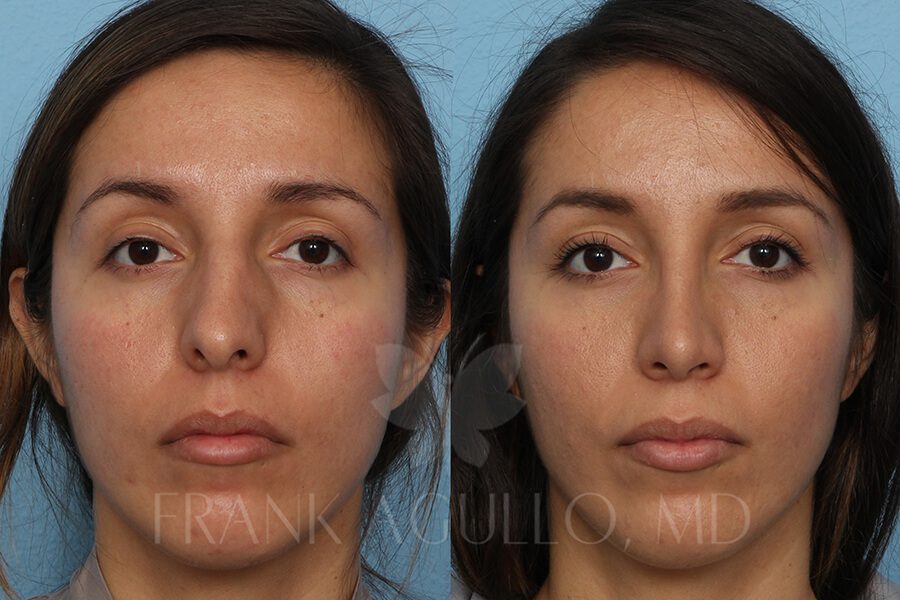 Rhinoplasty Before and After 7
