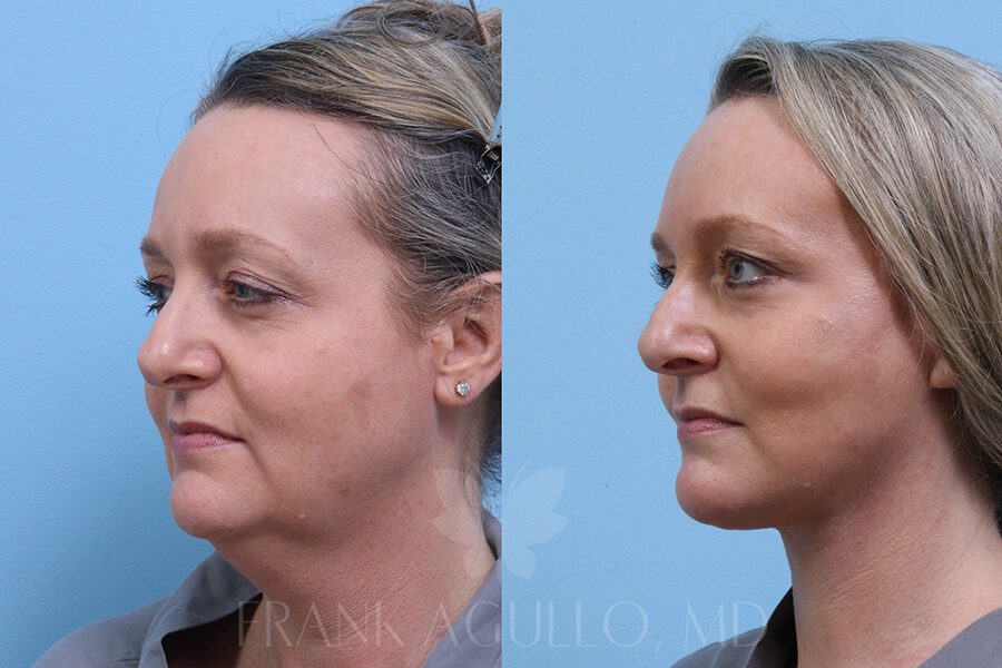 Face Lift Before and After 2