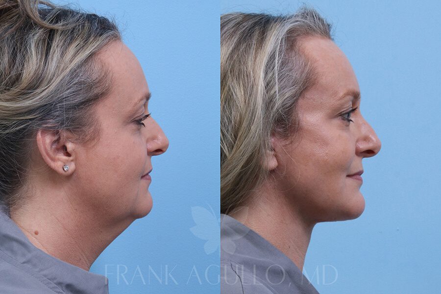 Face Lift Before and After 5