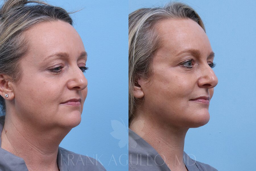 Face Lift Before and After 4