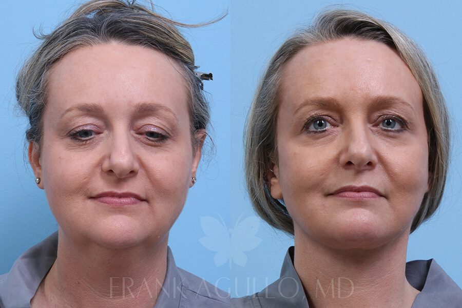 Face Lift Before and After 8