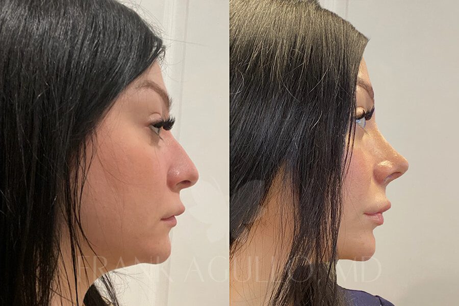 Rhinoplasty Before and After 2