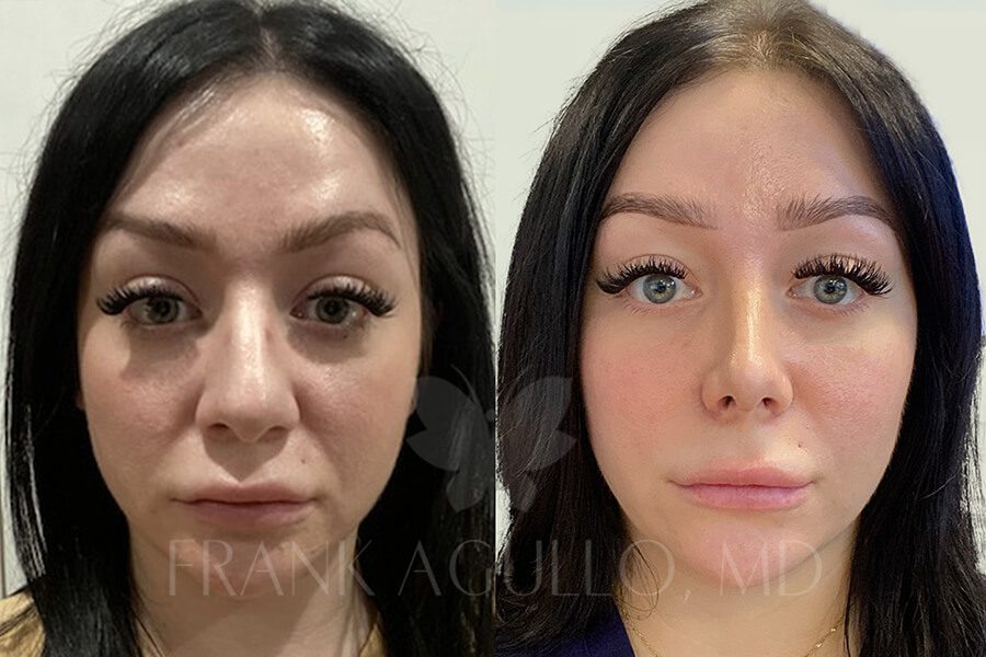 Rhinoplasty Before and After 8
