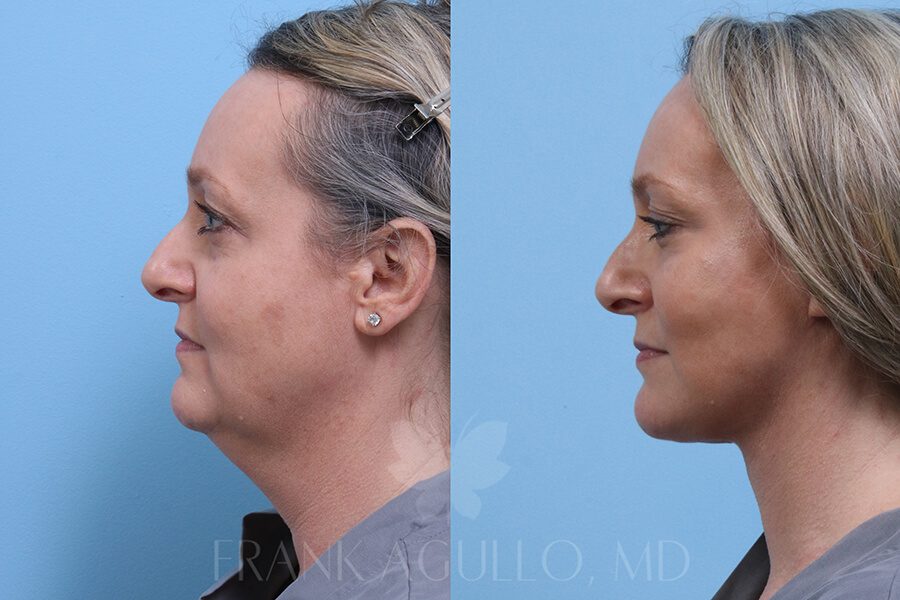 Face Lift Before and After 3