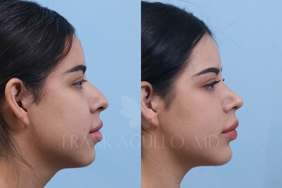 Rhinoplasty Before and After 3