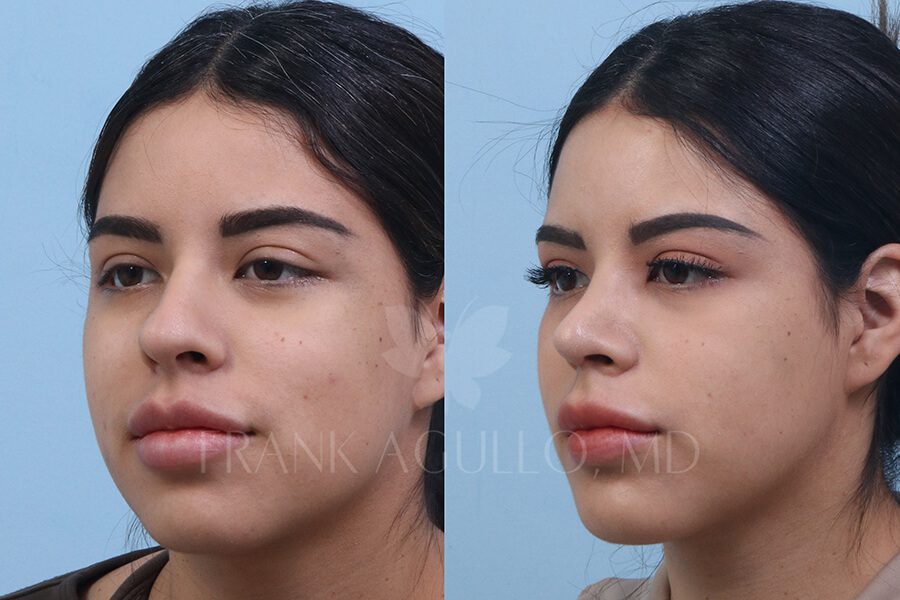 Rhinoplasty Before and After 2