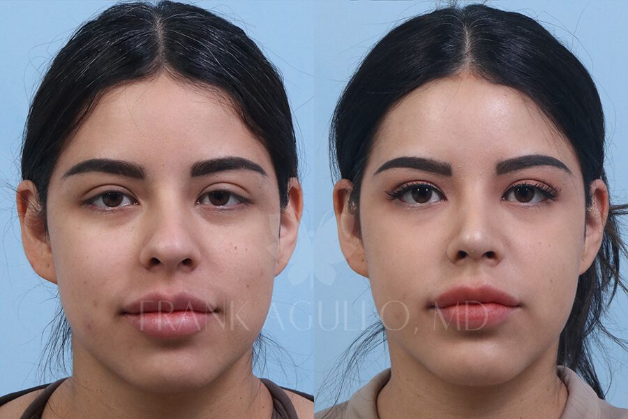 Rhinoplasty Before and After 9