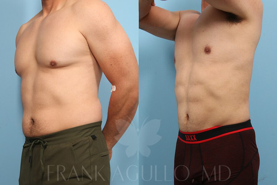 Etching Before and After 2