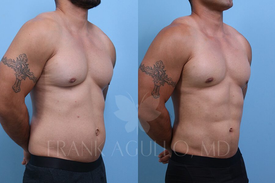 Etching Before and After 2