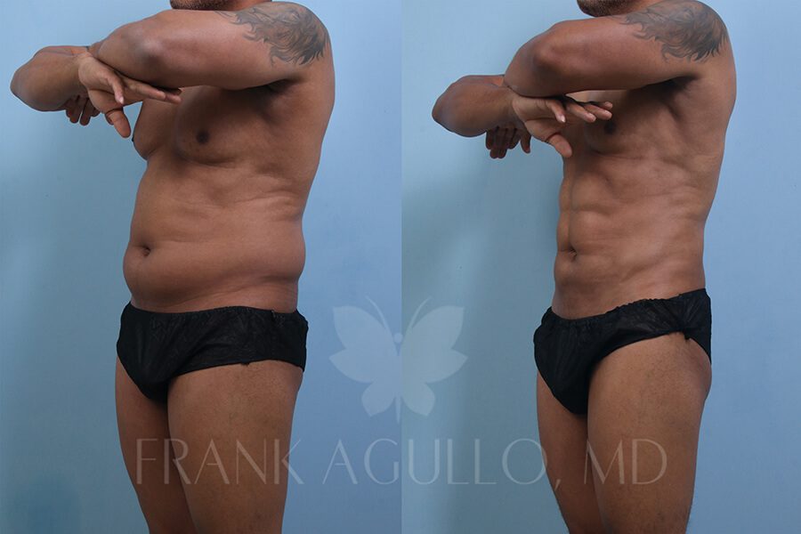 Etching Before and After 2