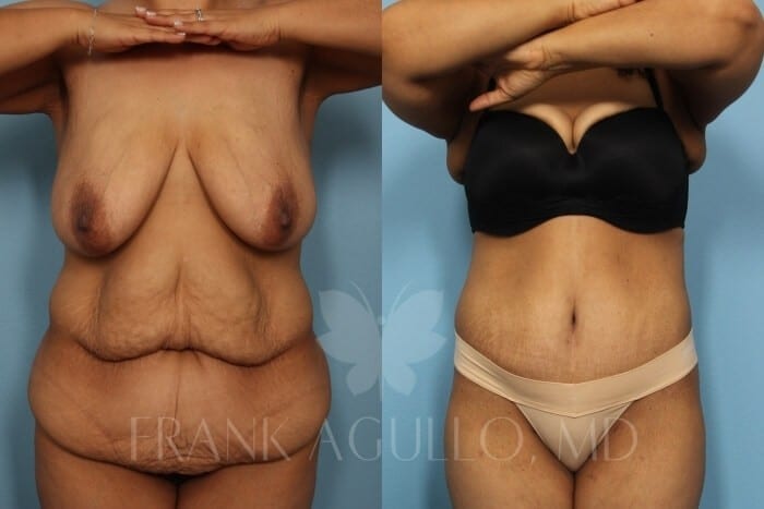 Tummy Tuck Before and After 9