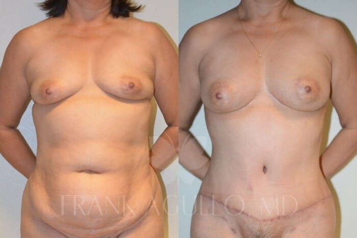 Tummy Tuck Before and After 10