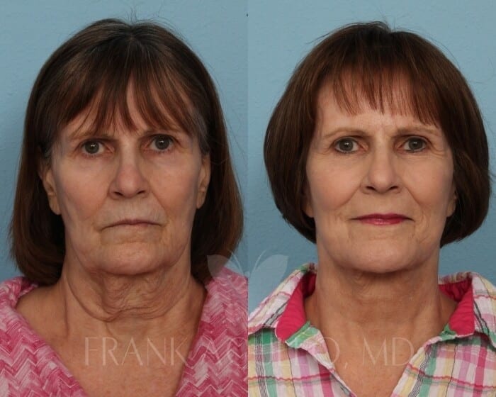 Face Lift Before and After 5