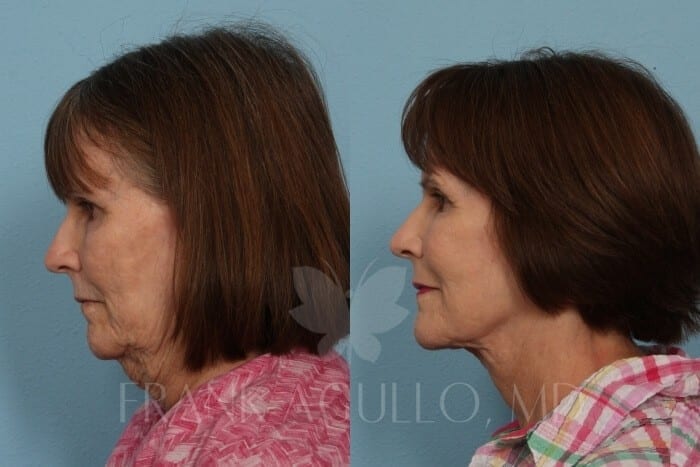 Neck Lift Before and After 1