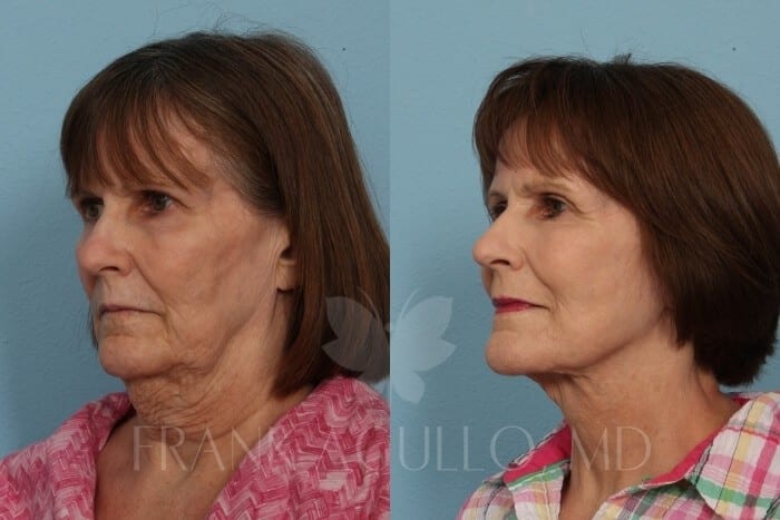 Face Lift Before and After 3