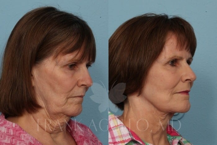 Face Lift Before and After 2