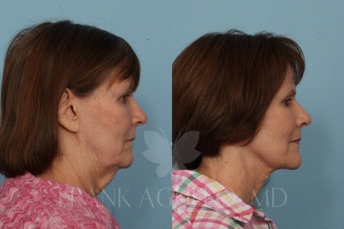 Face Lift Before and After 14