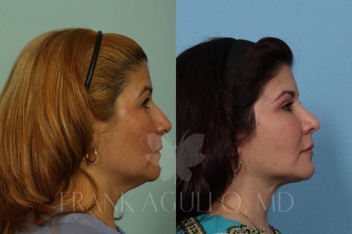 Face Lift Before and After 2