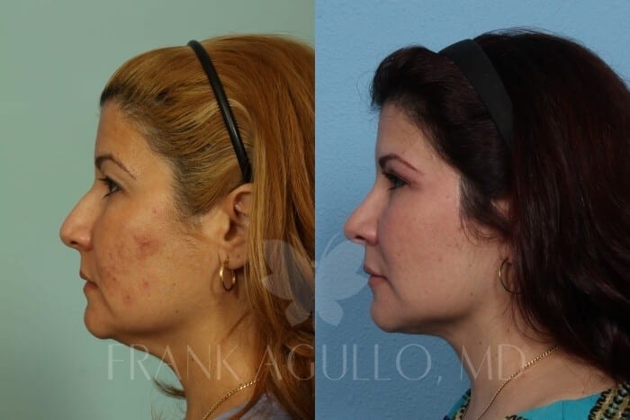 Face Lift Before and After 3