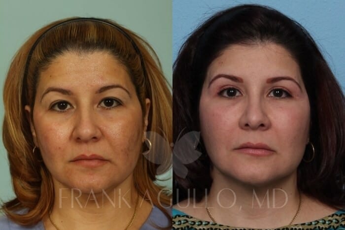 Face Lift Before and After 4