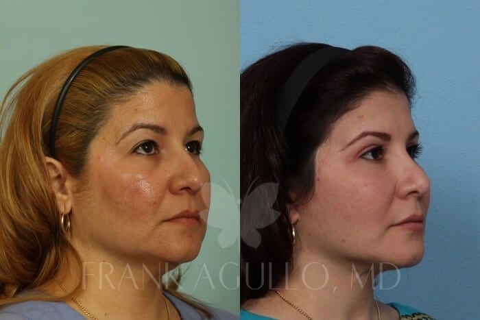 Face Lift Before and After 5