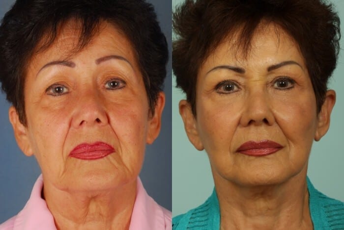 Face Lift Before and After 11