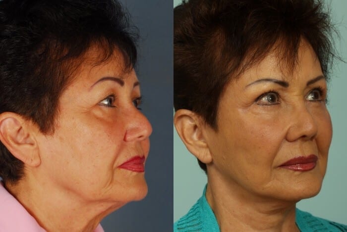 Face Lift Before and After 2