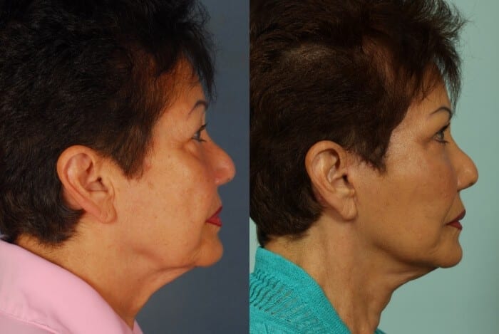 Face Lift Before and After 3