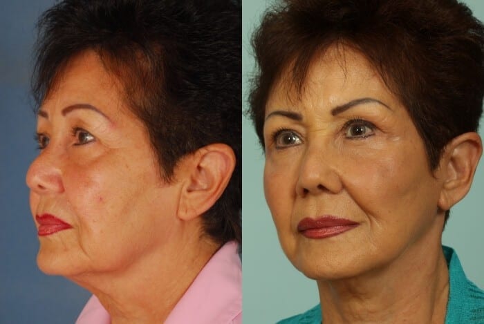 Face Lift Before and After 4