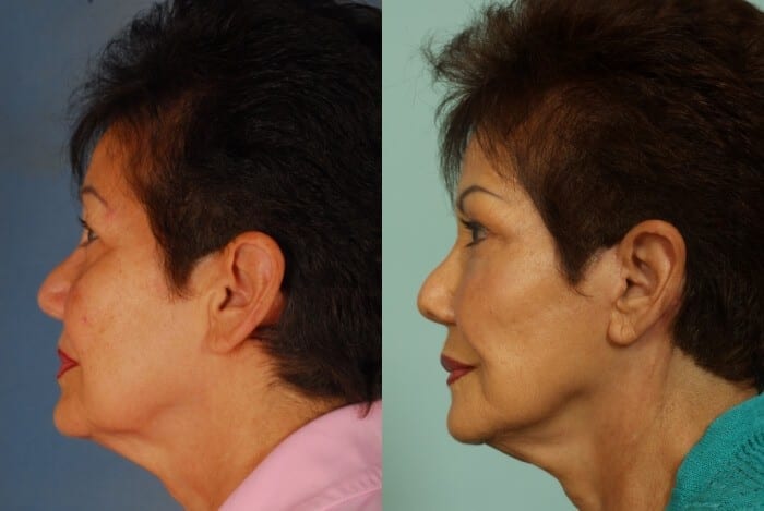 Face Lift Before and After 5