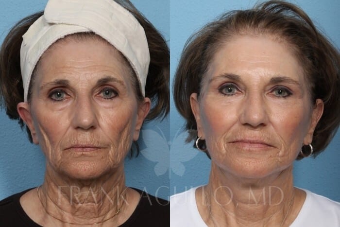 Face Lift Before and After 10