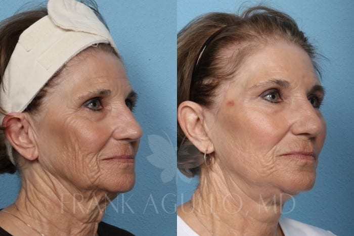 Face Lift Before and After 2