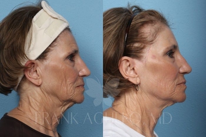 Face Lift Before and After 3
