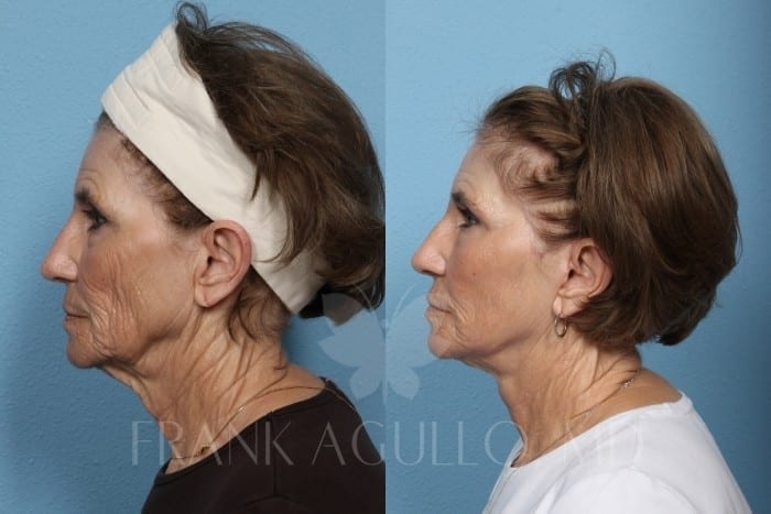 Face Lift Before and After 4