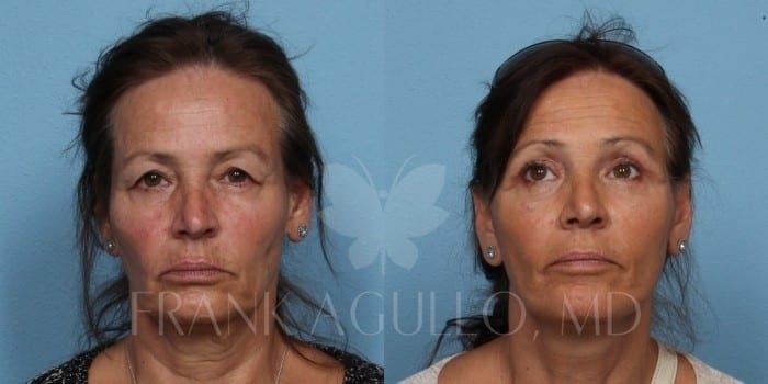 Face Lift Before and After 9