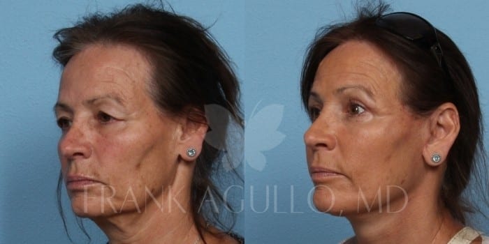 Face Lift Before and After 2