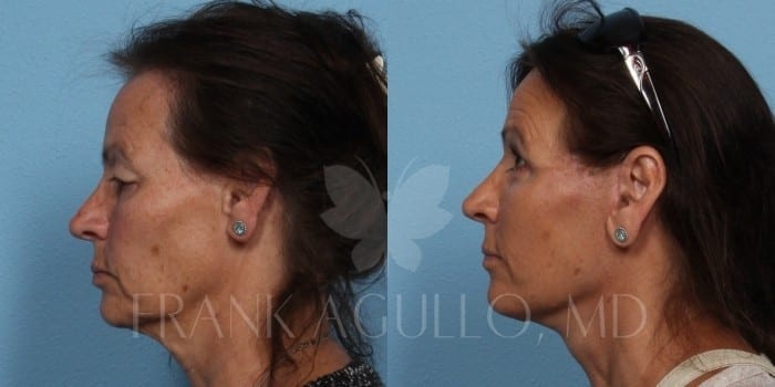 Face Lift Before and After 3