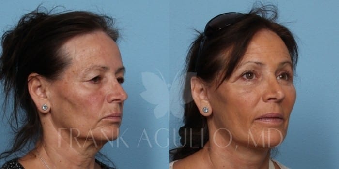Face Lift Before and After 4