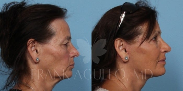 Face Lift Before and After 5
