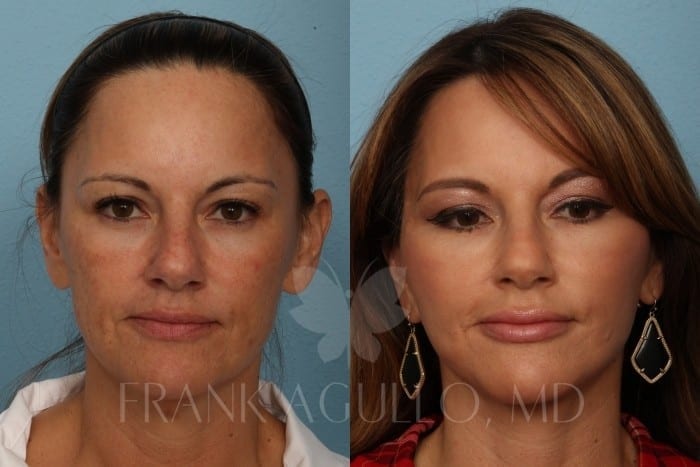 Face Lift Before and After 8