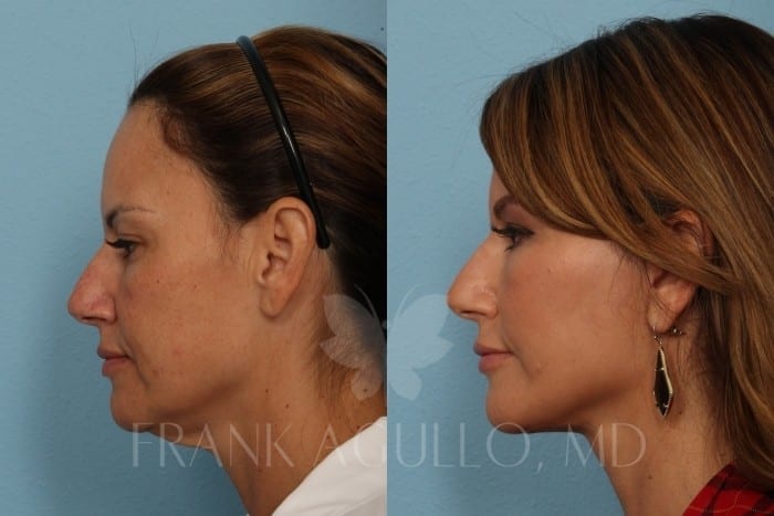 Face Lift Before and After 2